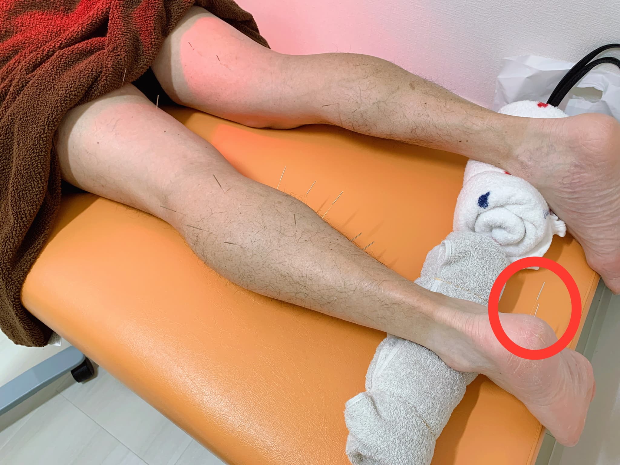 足底腱膜炎に対する鍼治療