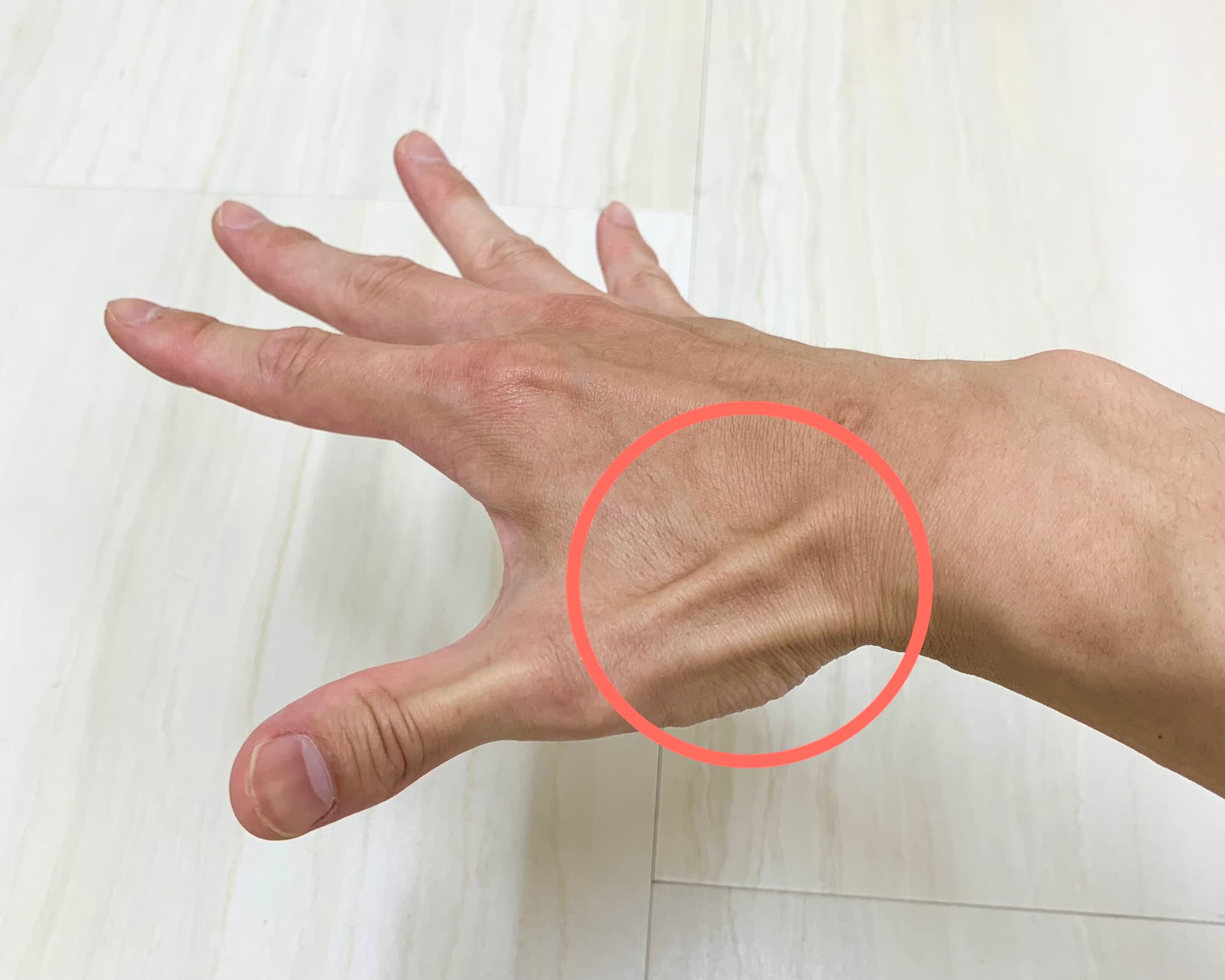 フィンケルシュタイン検査陽性とは何を意味しますか?