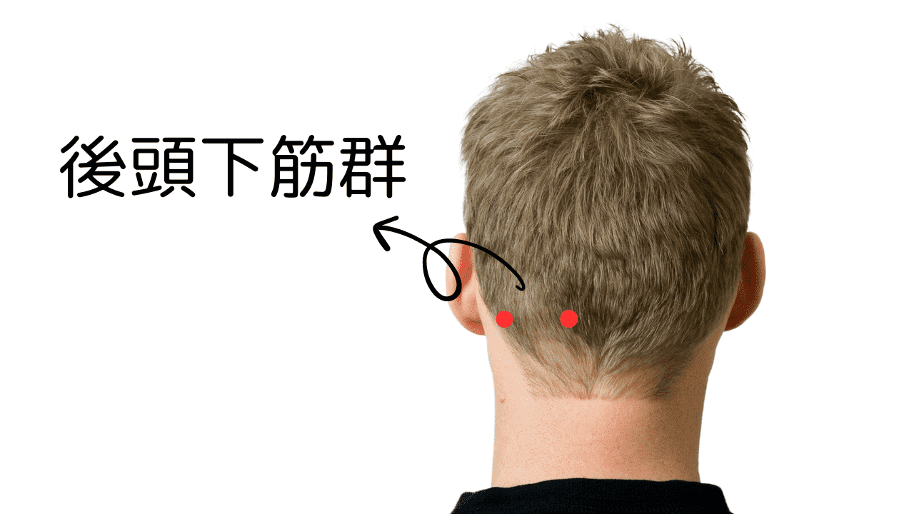 筋緊張性頭痛の原因の一つである後頭下筋