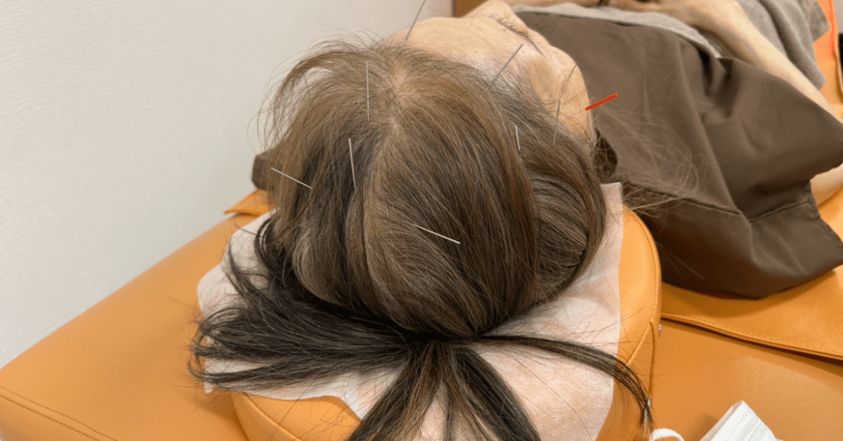 頭部や顔面部に鍼をしている様子