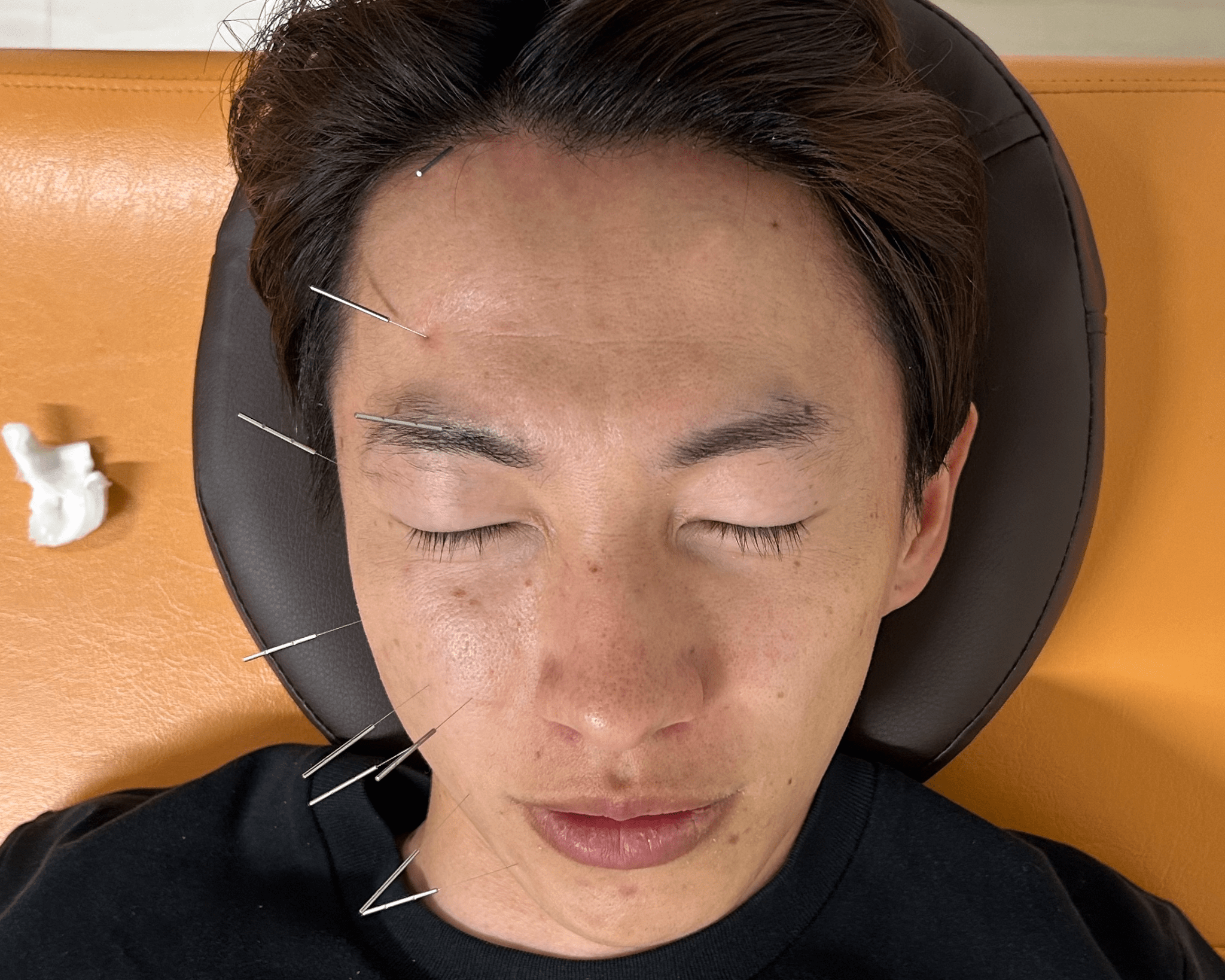 顔面神経麻痺に対する鍼治療の実際の様子