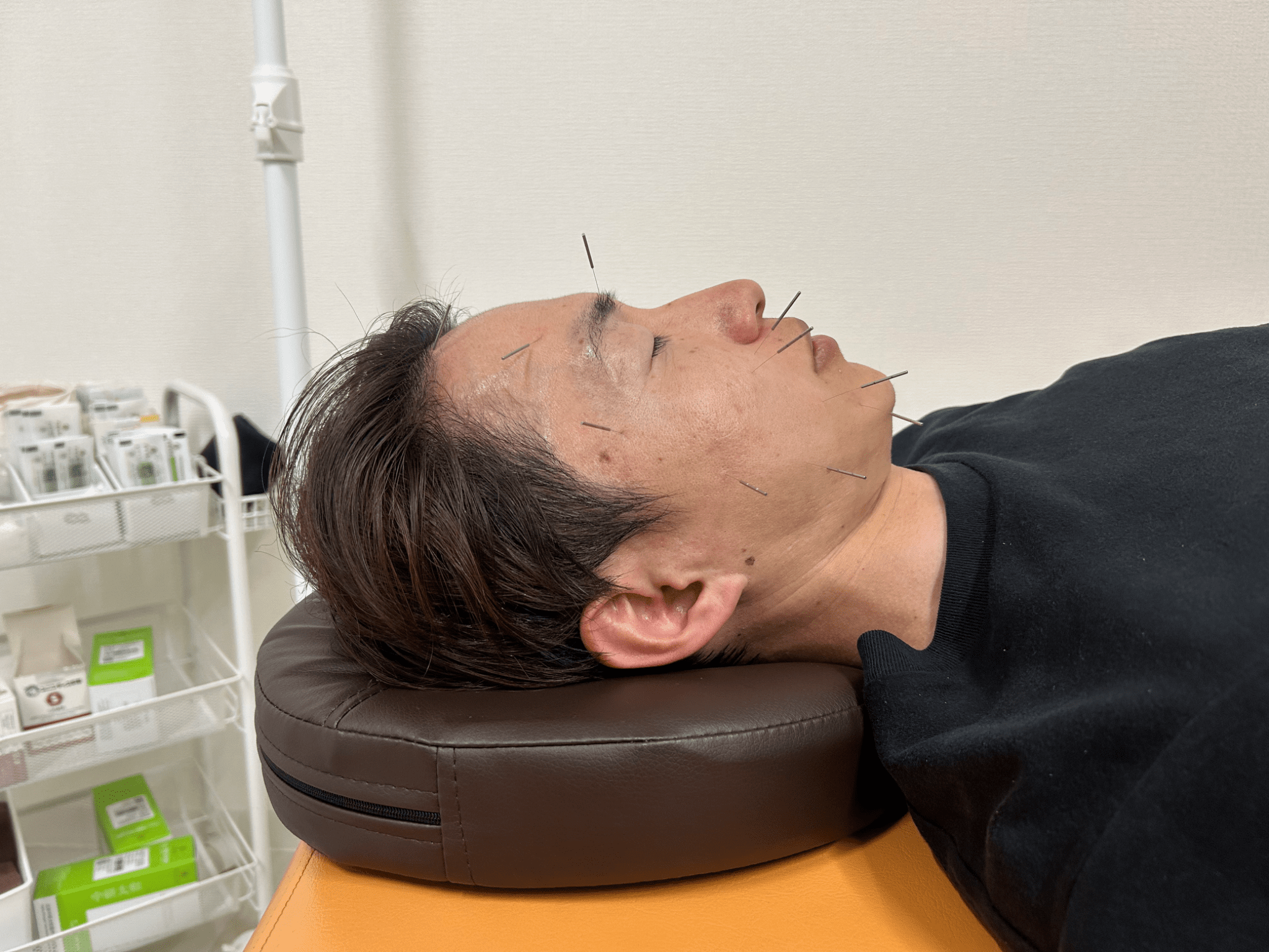 顔面神経麻痺に対する当院での実際の鍼治療の様子