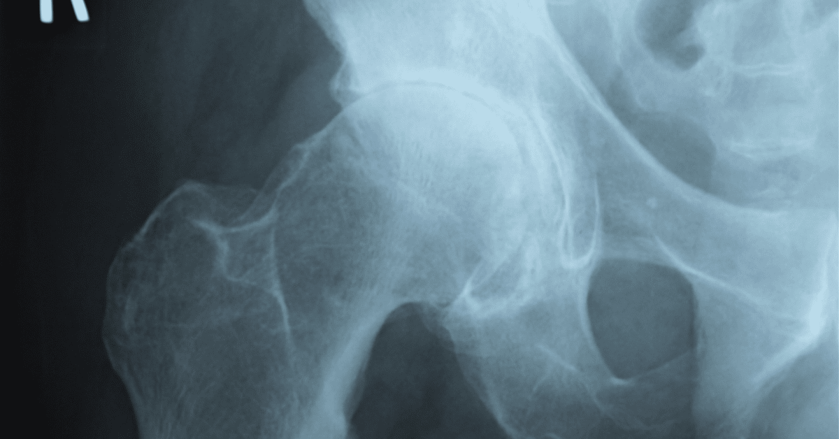 股関節の変形