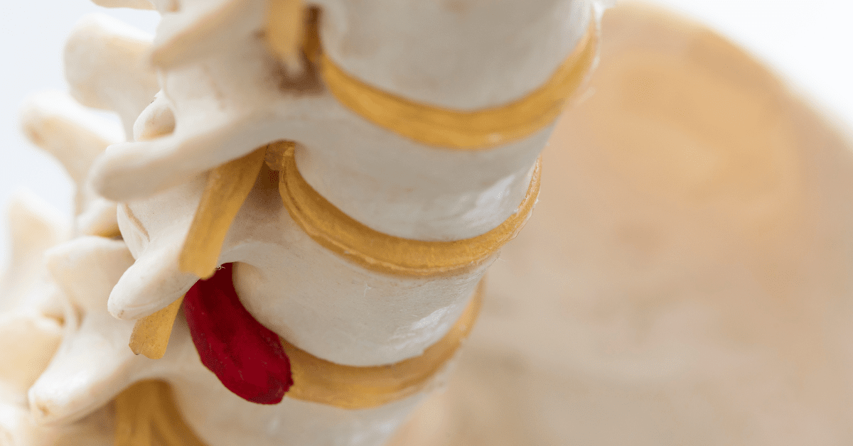 ヘルニアによって大腿神経痛が出現する場合も