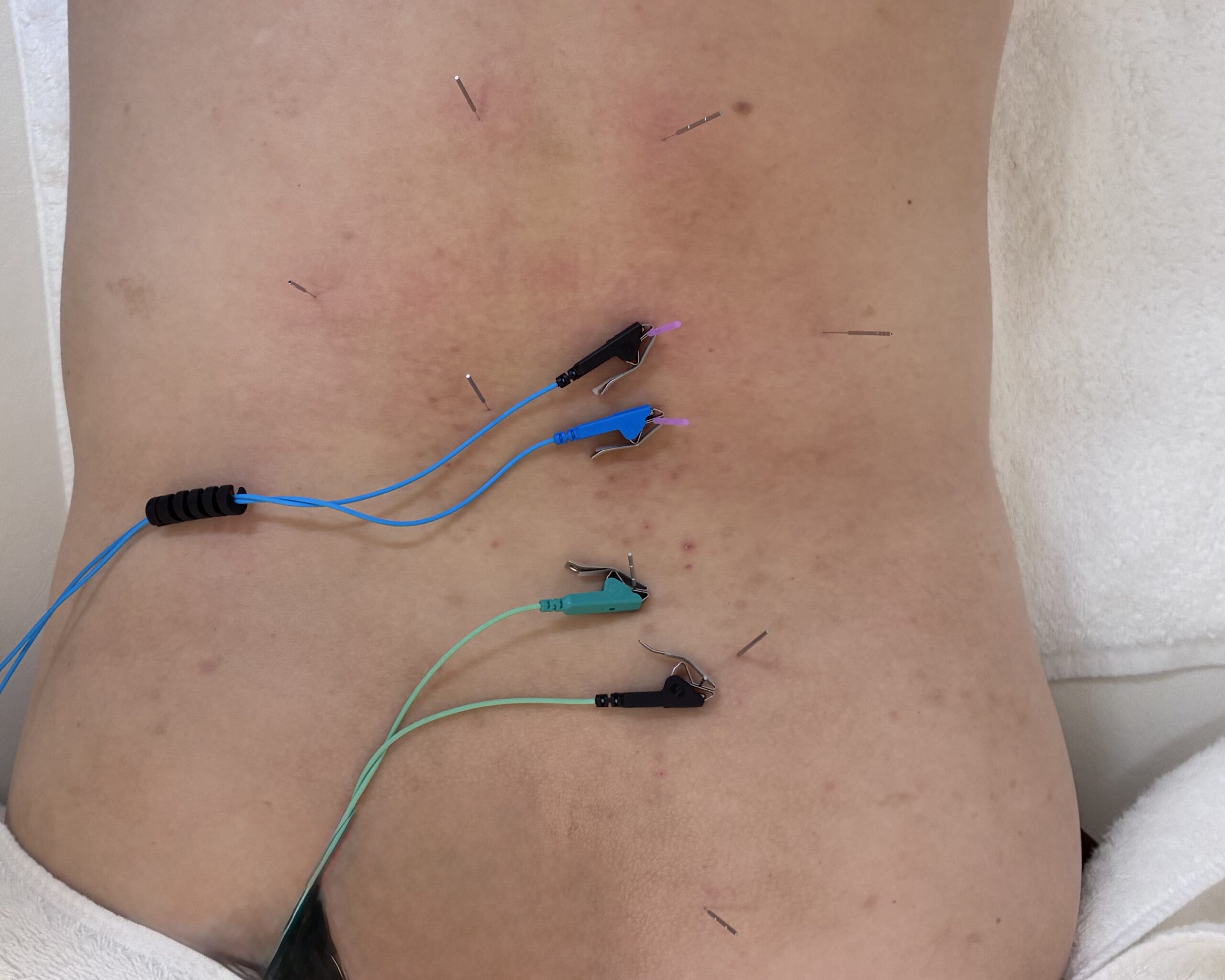 仙腸関節性腰痛に対する鍼治療の一例